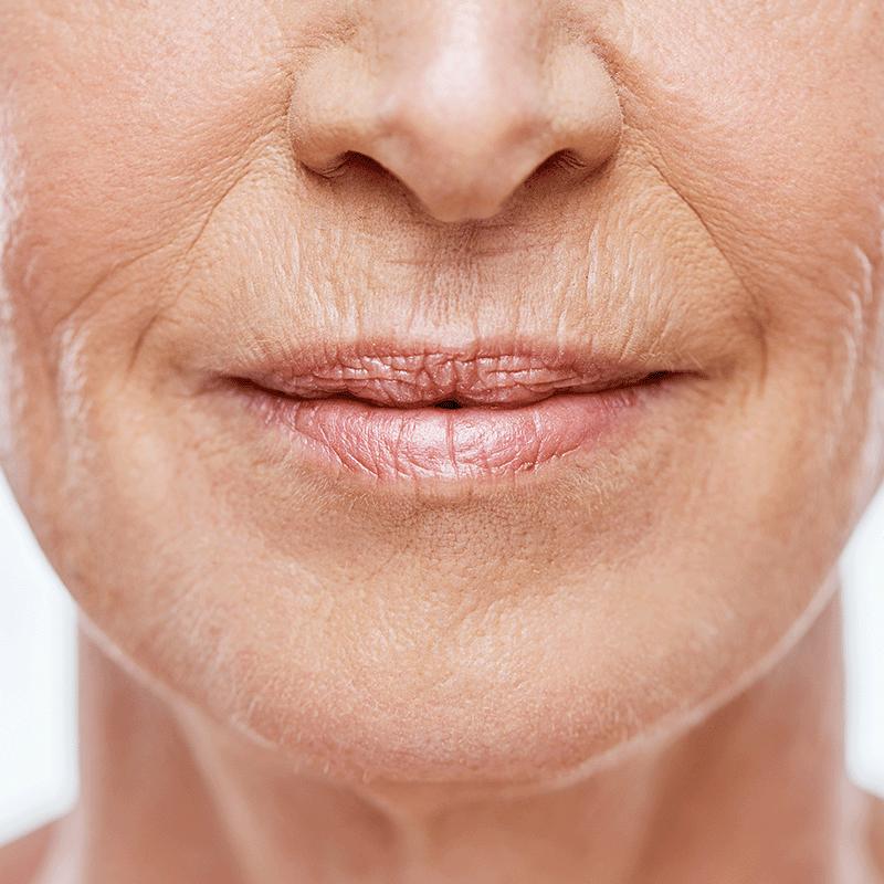 Aging Skin